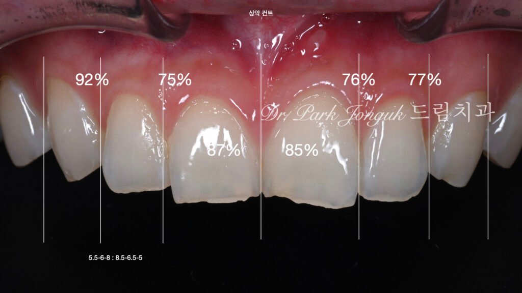 라미네이트를 위한 정밀진단 단계