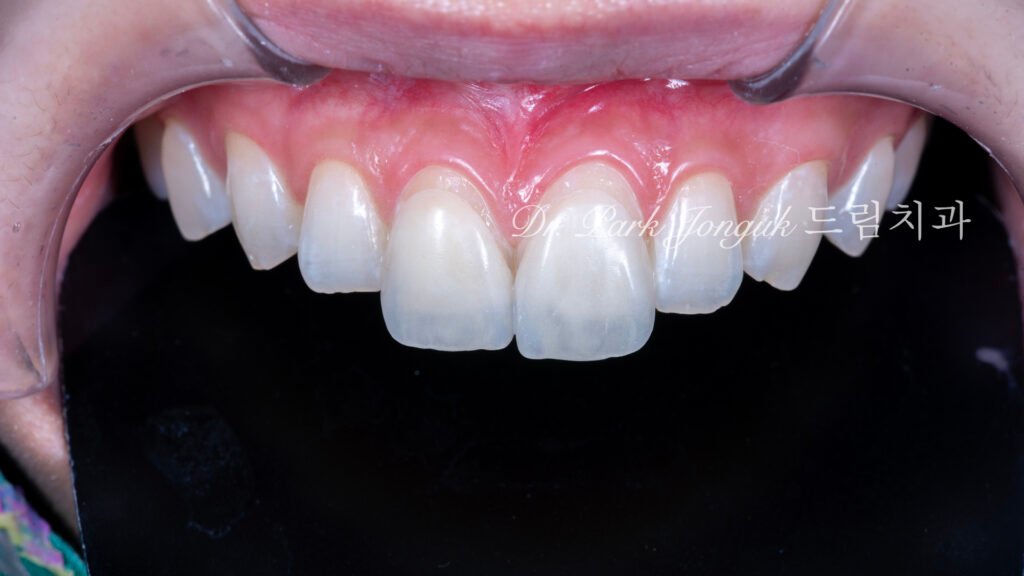 자연스럽고 아름다운 라미네이트