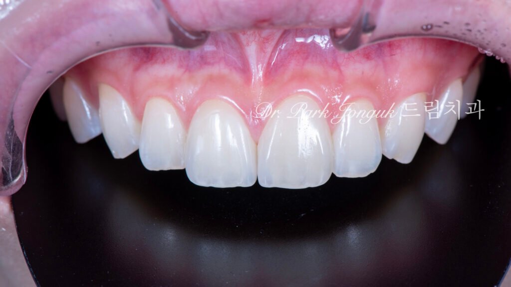 자연스럽고 아름다운 라미네이트