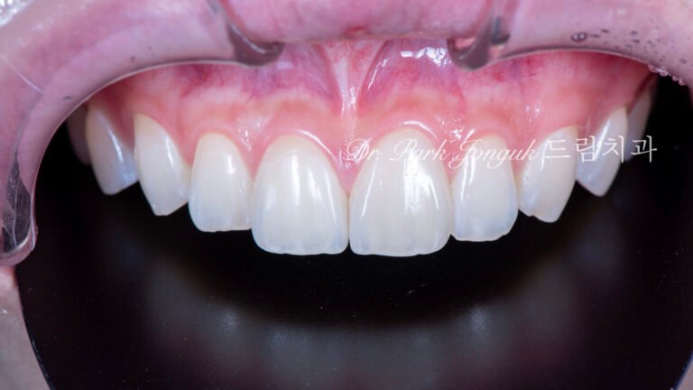 자연스러운 라미네이트