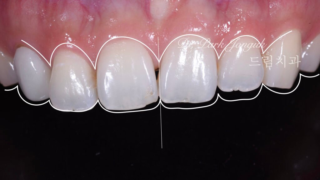 앞니 라미네이트를 위한 왁스업 정밀진단