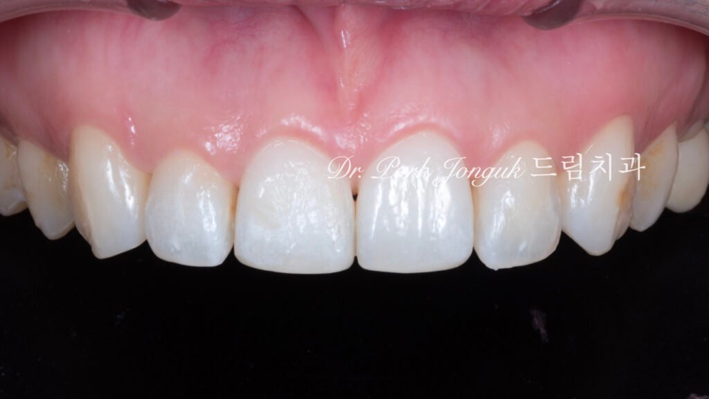 교정후 라미네이트를 위해 내원