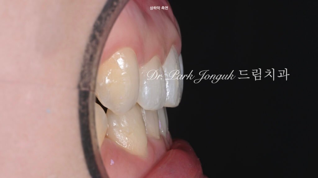 교정후 라미네이트를 위한 왁스업 정밀진단과정