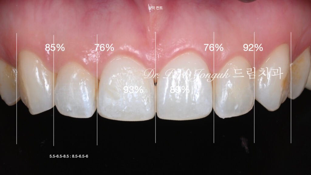 교정후 라미네이트를 위한 왁스업 정밀진단과정