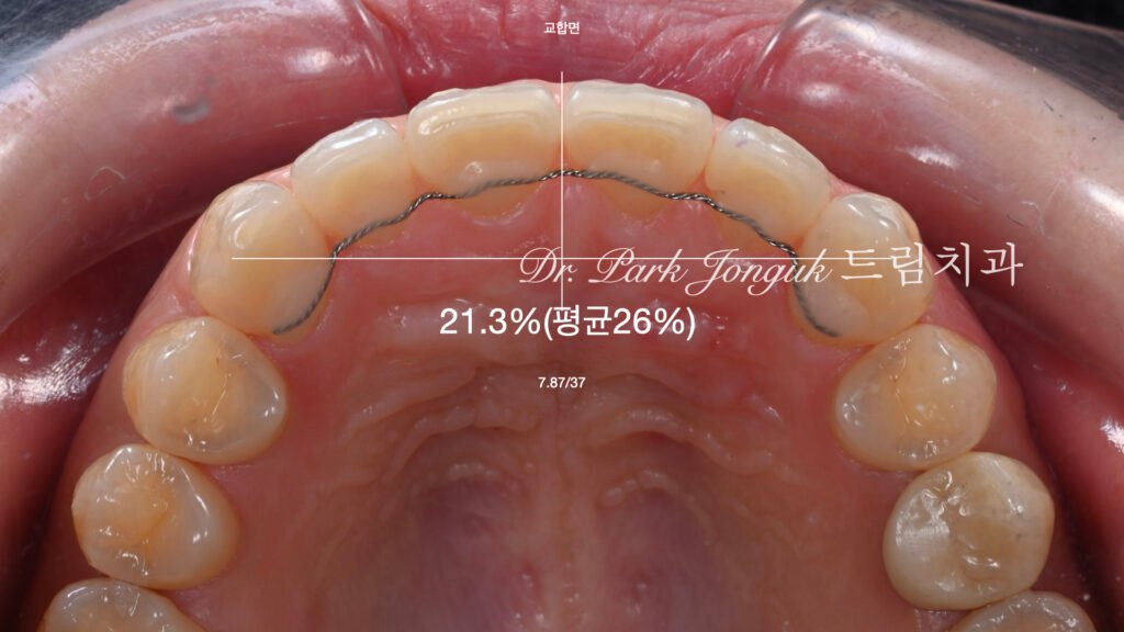 교정후 라미네이트를 위한 왁스업 정밀진단과정