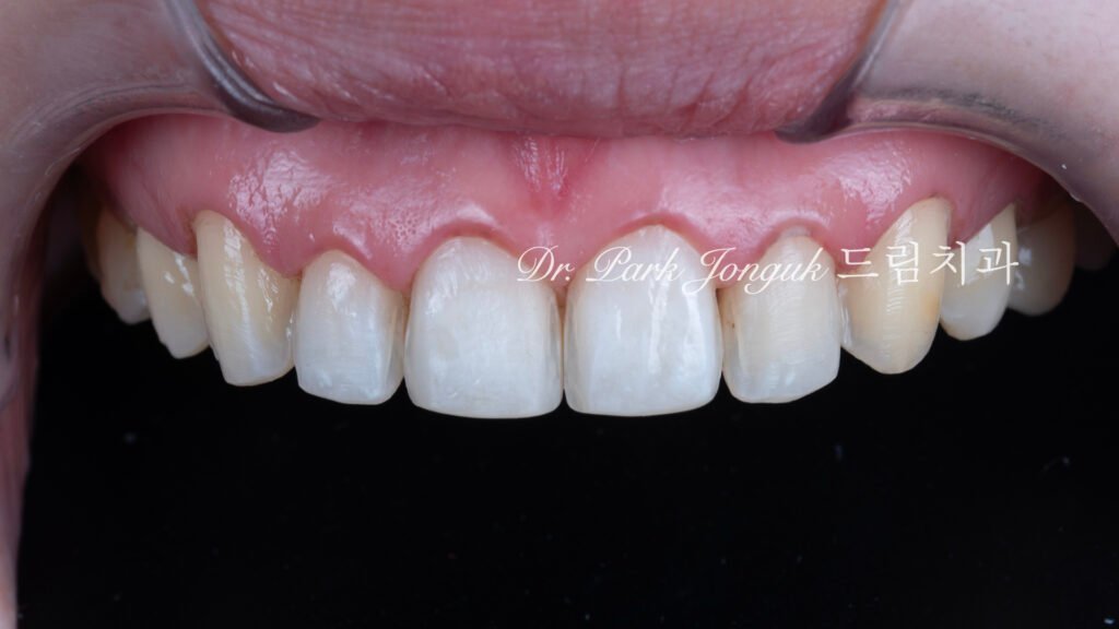 교정 후 라미네이트를 위한 미세삭제