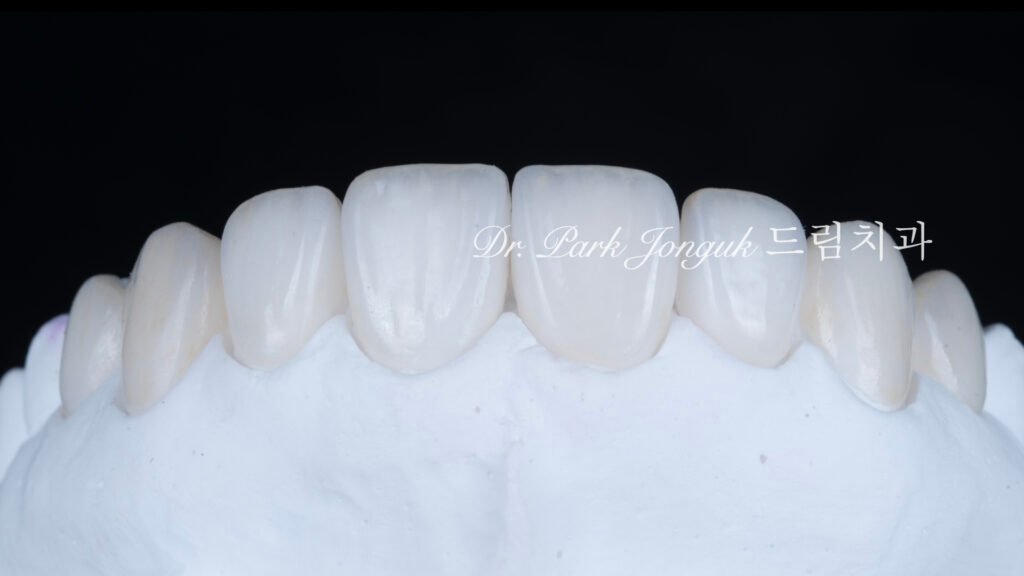 자연스럽고 아름다운 라미네이트