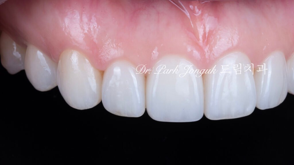 자연스럽고 아름다운 라미네이트