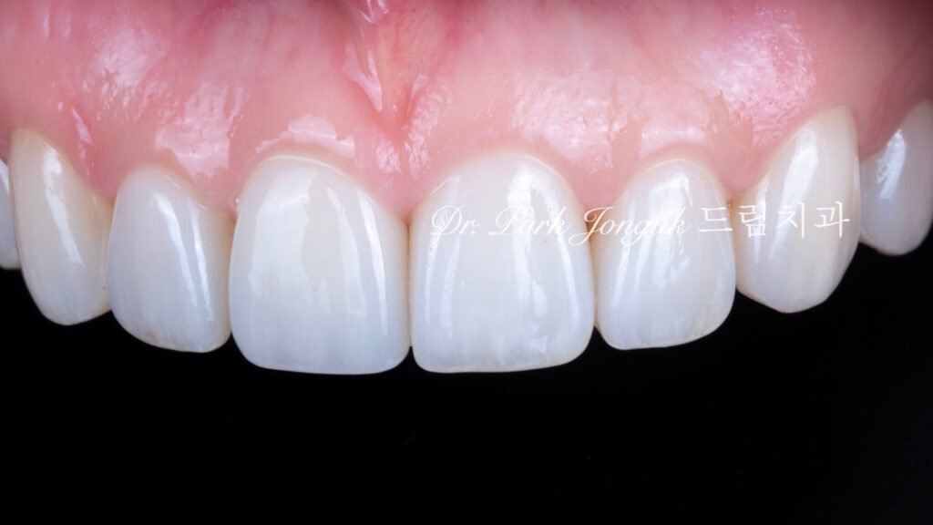 자연스럽고 아름다운 라미네이트