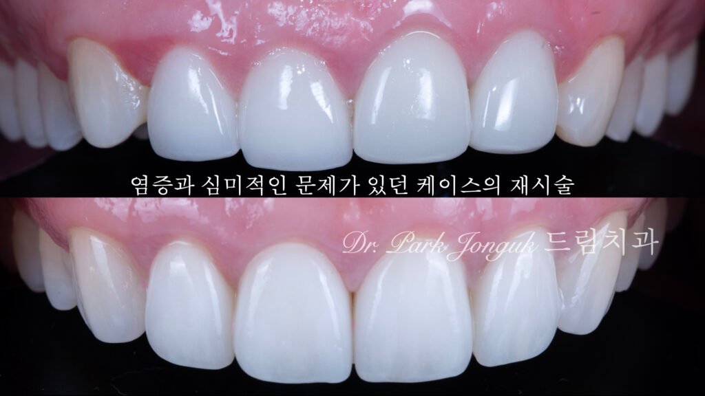 Laminate veneer re-treatment