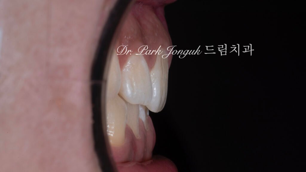 옥니상태는 무삭제 라미네이트에 유리