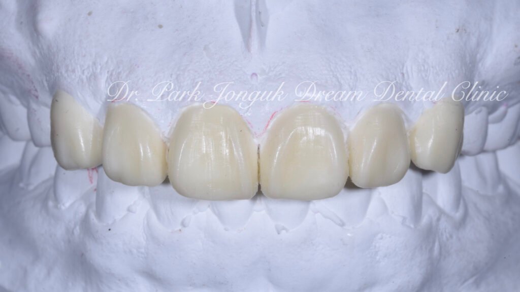 무삭제 라미네이트를 위한 왁스업