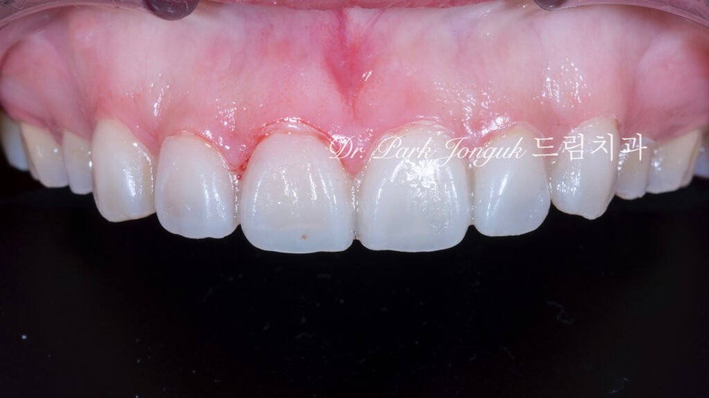 무삭제 라미네이트용 임시치아