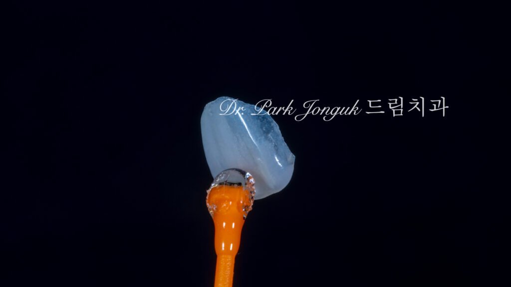 무삭제 라미네이트