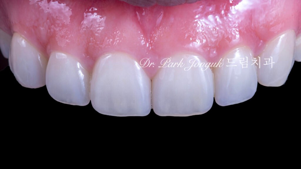 무삭제 라미네이트