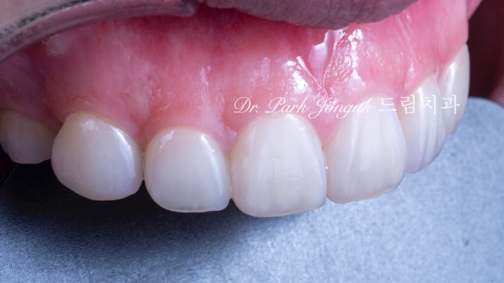 무삭제 라미네이트