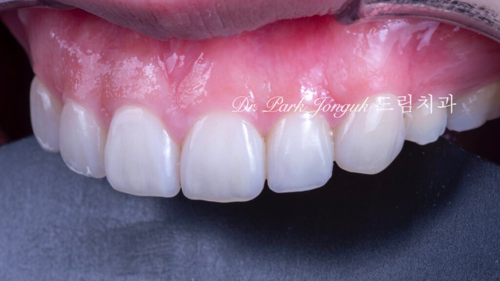 무삭제 라미네이트