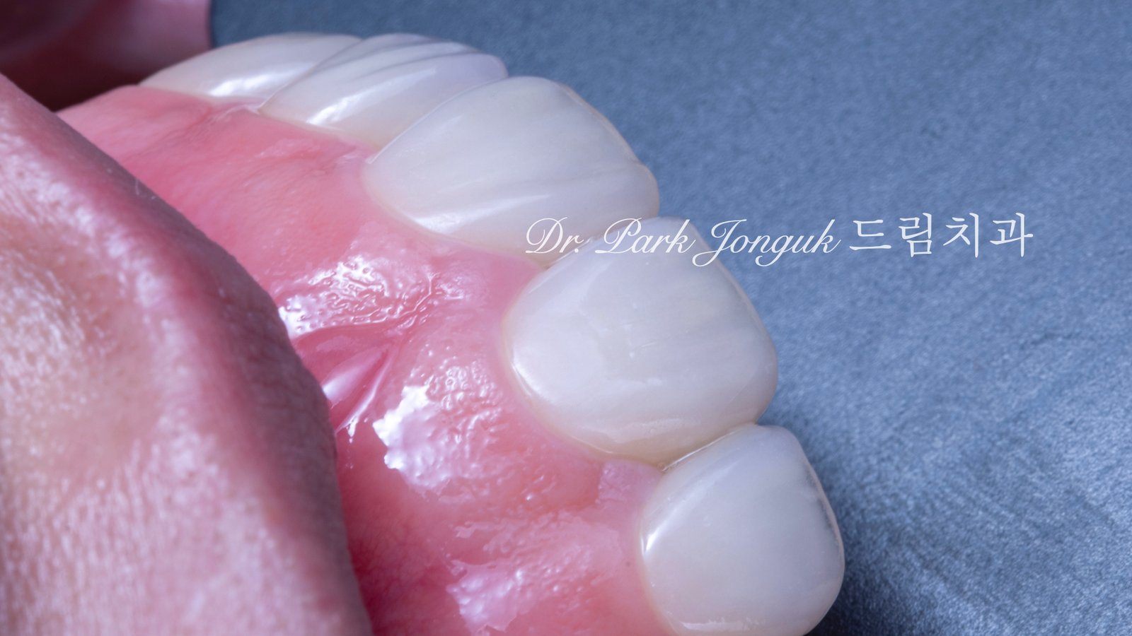 무삭제 라미네이트