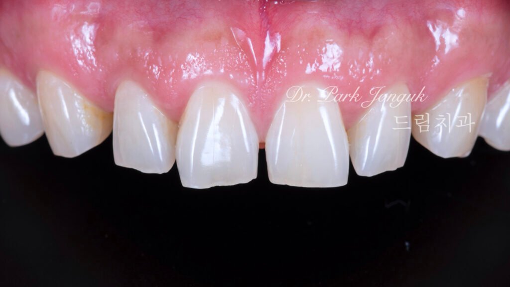 50대 남자 벌어진 치아로 젊어보이기 위해 라미네이트 치료를 위해 내원