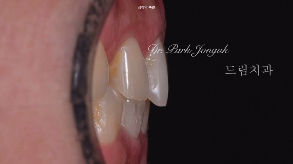 라미네이트 진단과정