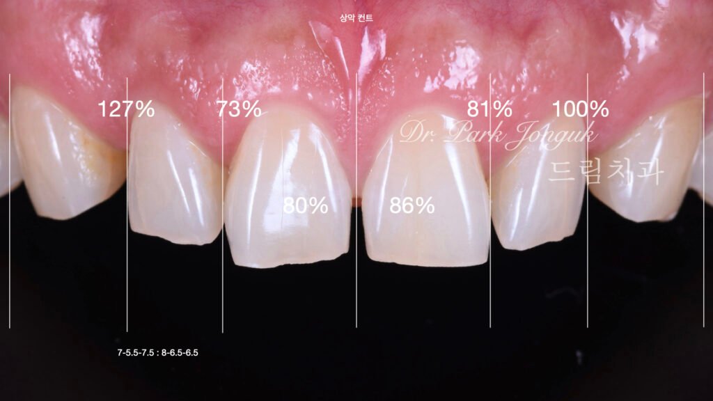 라미네이트 진단과정