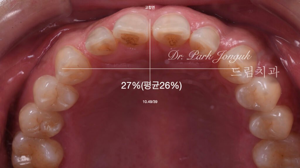 라미네이트 진단과정