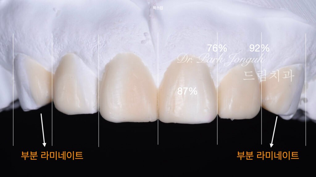 라미네이트 진단과정