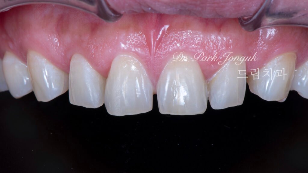 라미네이트를 위한 미세한 삭제