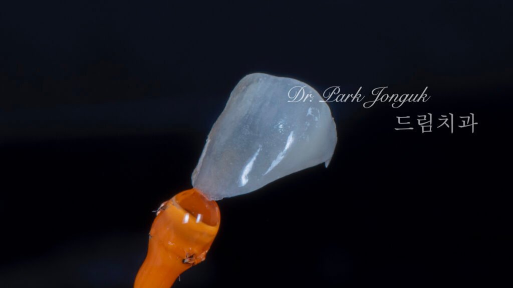 자연스럽고 아름다운 무삭제 라미네이트