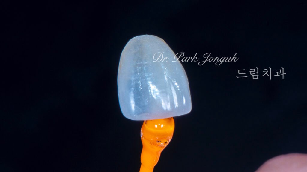 자연스럽고 아름다운 무삭제 라미네이트