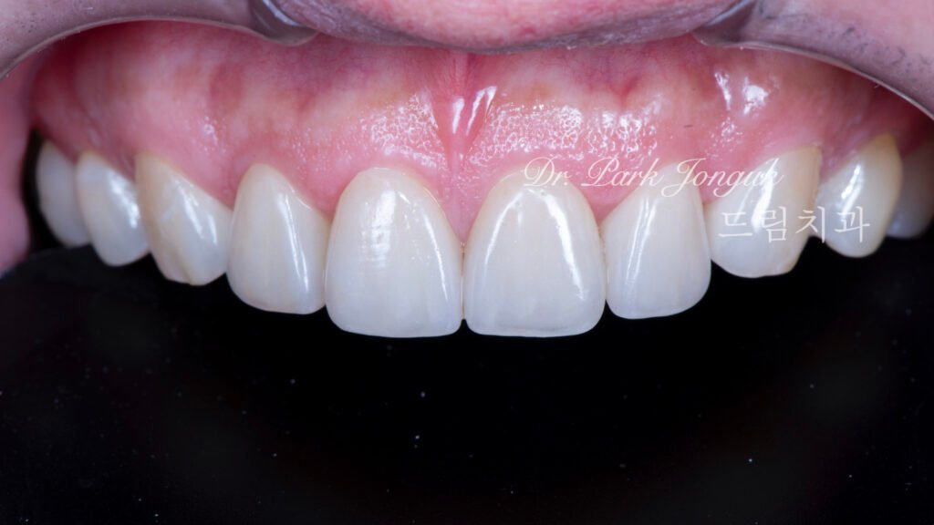 자연스럽고 아름다운 무삭제 라미네이트