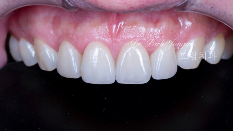 자연스럽고 아름다운 무삭제 라미네이트