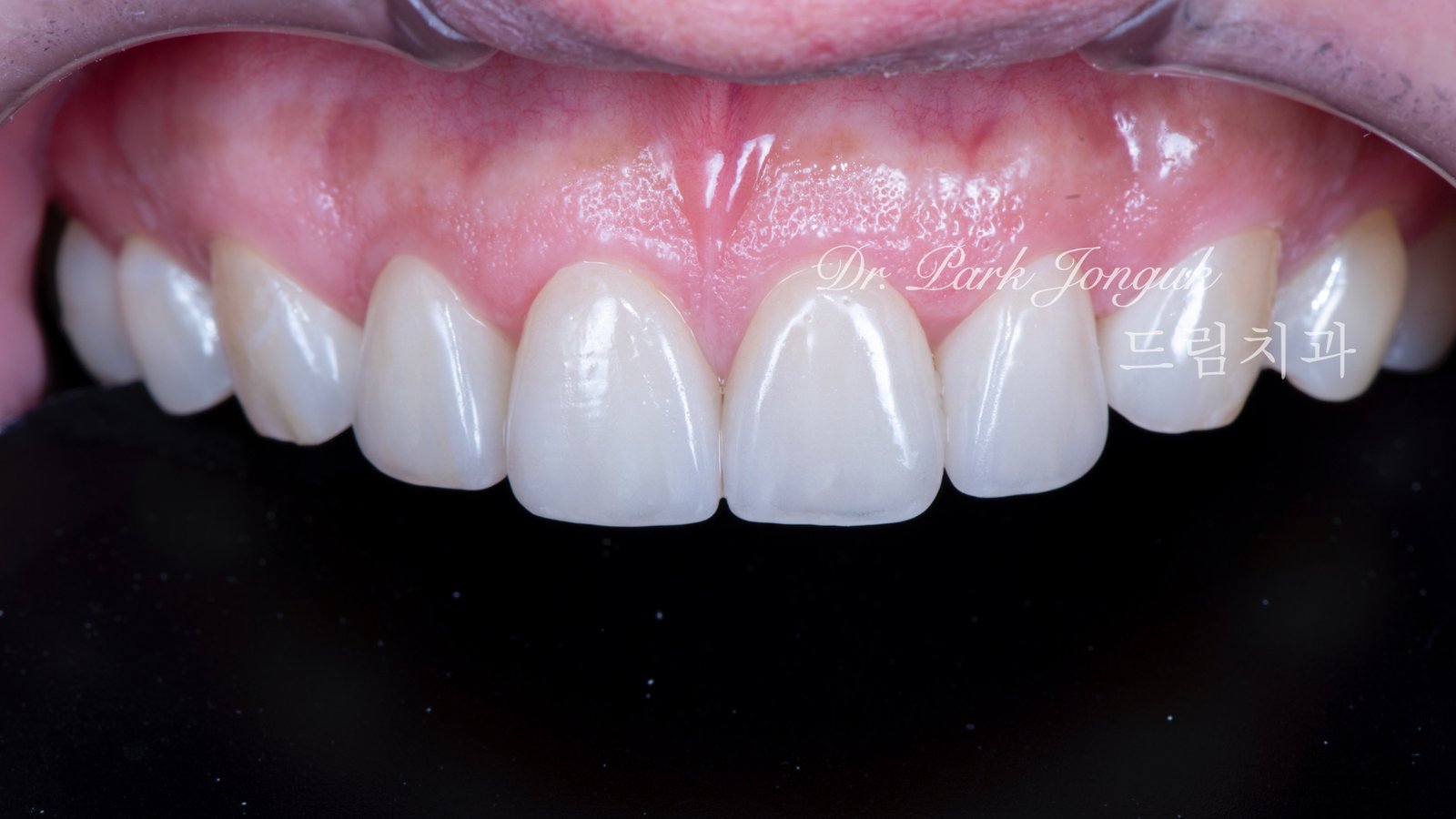 자연스럽고 아름다운 무삭제 라미네이트