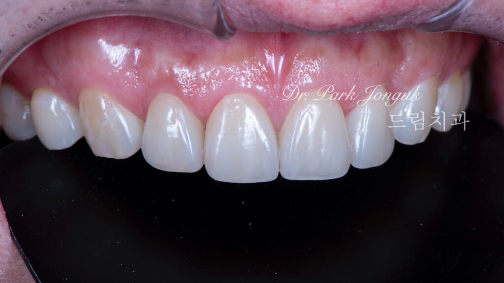 자연스럽고 아름다운 무삭제 라미네이트