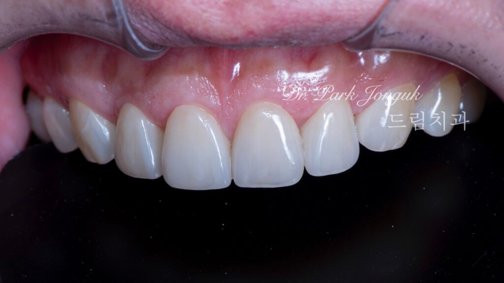 자연스럽고 아름다운 무삭제 라미네이트