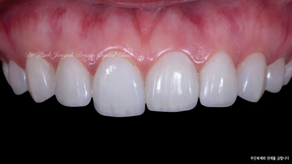 라미네이트 세팅중
