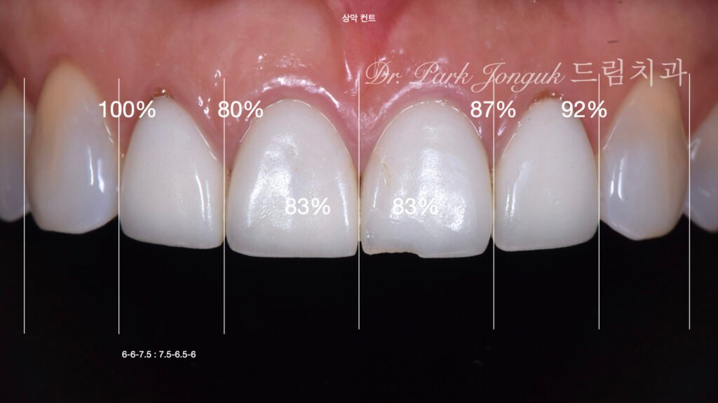 라미네이트 재시술을 위한 진단과정