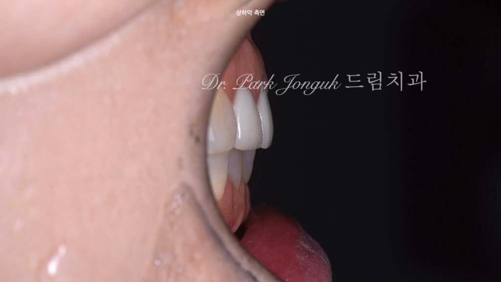 라미네이트 재시술을 위한 진단과정