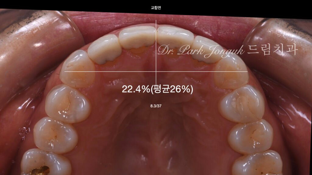 라미네이트 재시술을 위한 진단과정