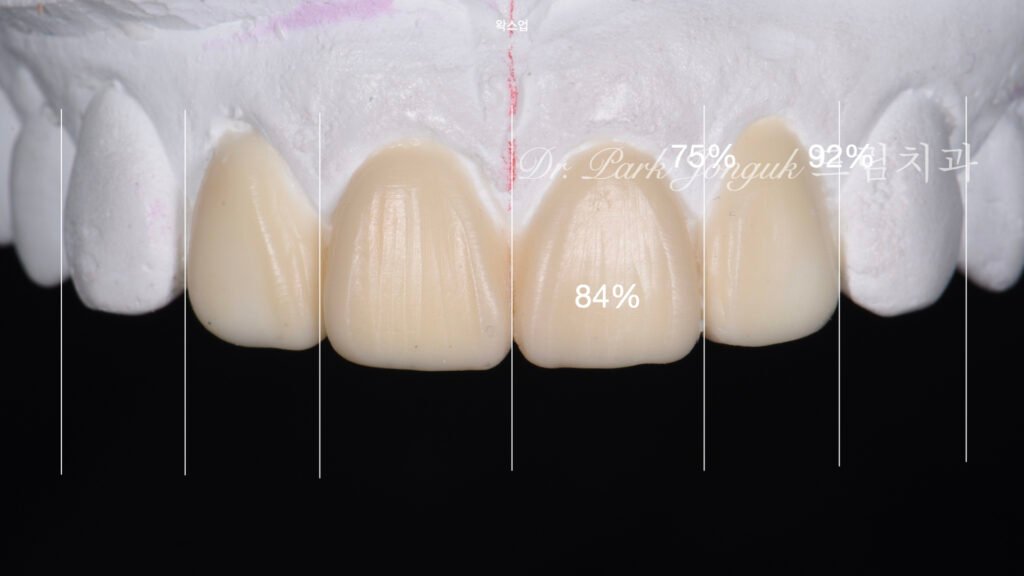 라미네이트 재시술을 위한 진단과정