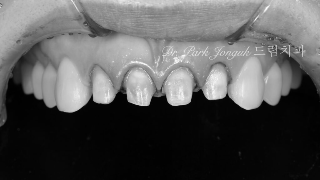 기존 보철물을 제거한 상태