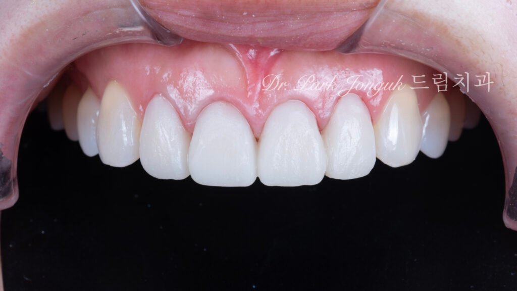 라미네이트 올세라믹 크라운 재시술에서 필수적인 임시치아 과정