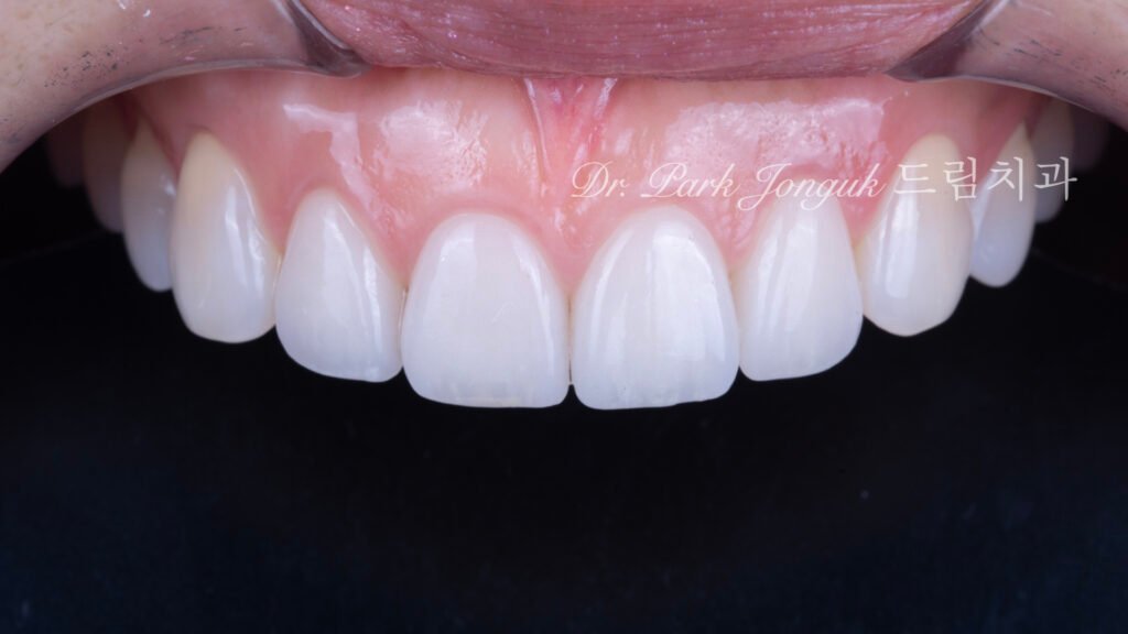 투명감이 살아있는 자연스럽고 아름다운 라미네이트 올세라믹 크라운