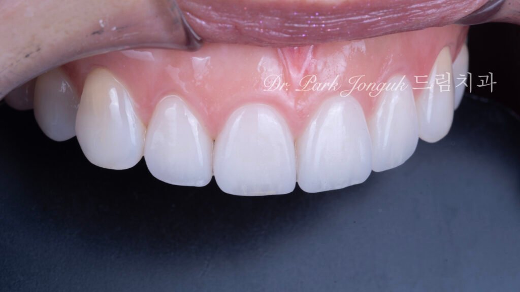 투명감이 살아있는 자연스럽고 아름다운 라미네이트 올세라믹 크라운