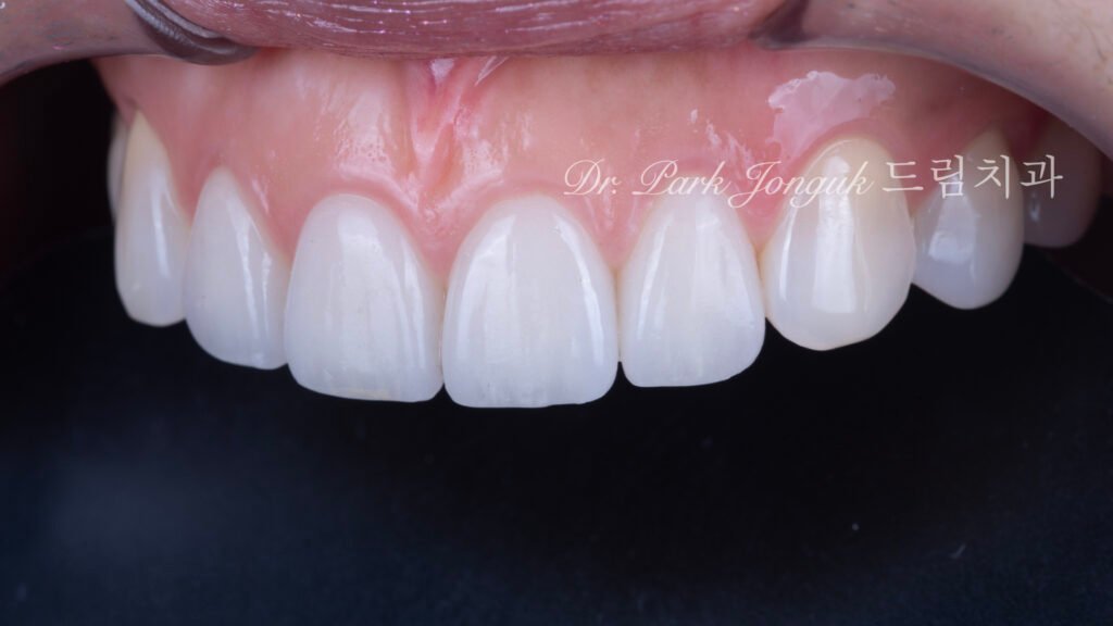 투명감이 살아있는 자연스럽고 아름다운 라미네이트 올세라믹 크라운