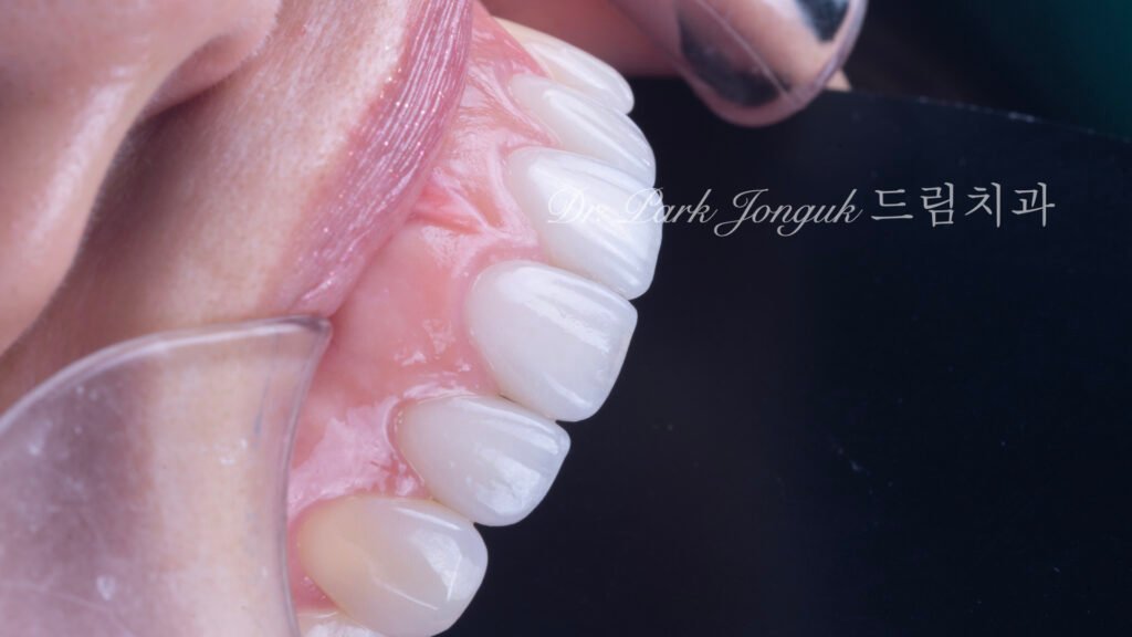 투명감이 살아있는 자연스럽고 아름다운 라미네이트 올세라믹 크라운