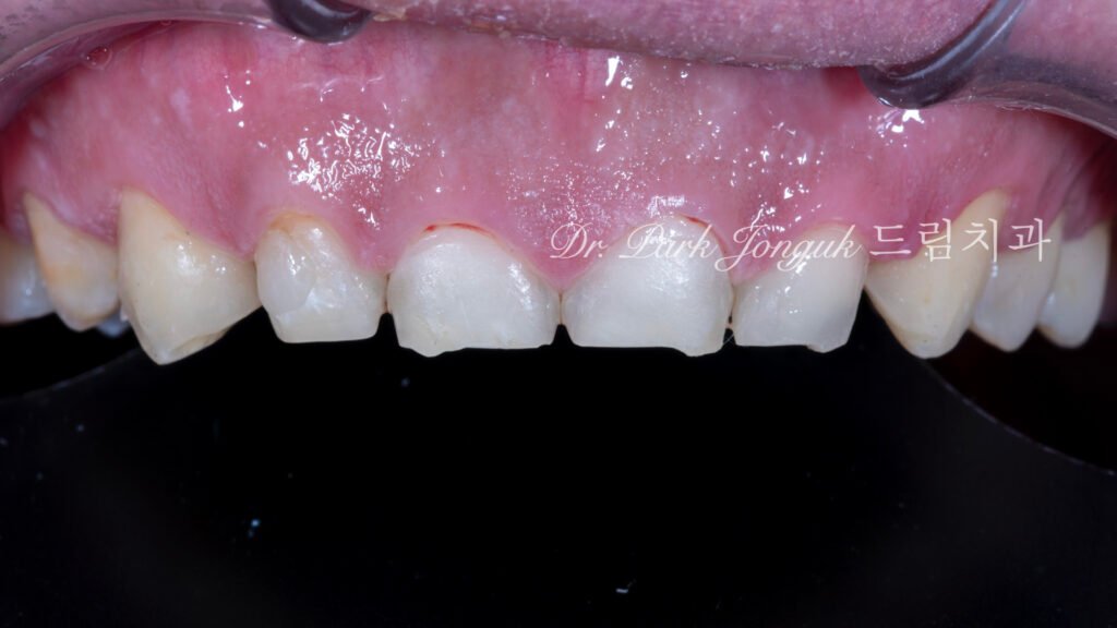 역류성식도염과 마모로 인해 무삭제 라미네이트 치료를 받기 위해 내원