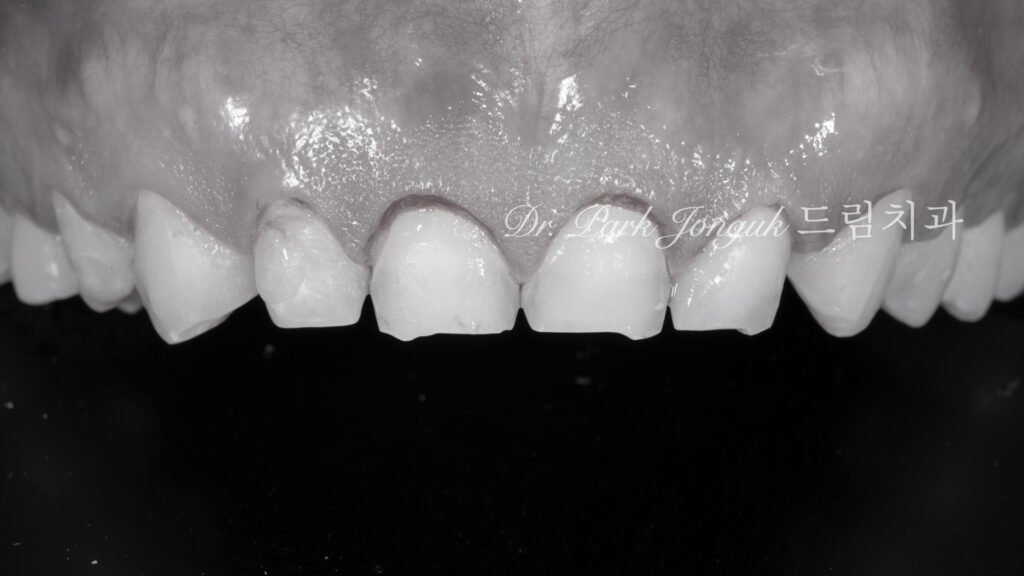 라미네이트를 위한 잇몸 성형