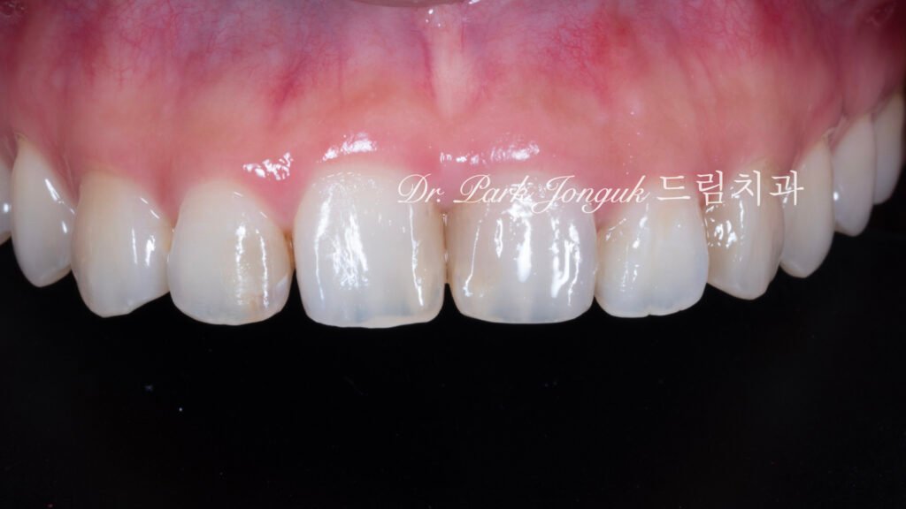 교정후 앞니충치 변색으로 라미네이트 치료를 위해 내원