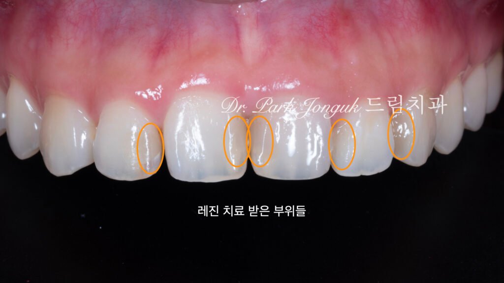 교정후 앞니충치 변색으로 라미네이트 치료를 위해 내원